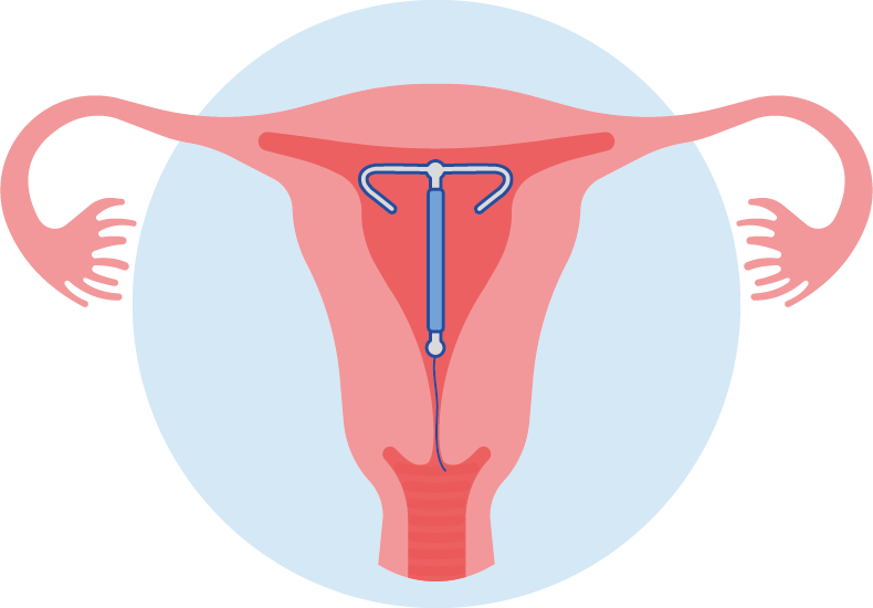 flexi-t in uterus